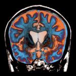 Dans une première, la maladie de Huntington est ralentie par un traitement expérimental