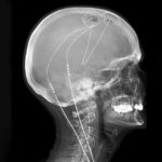 L'implant cérébral sur mesure soutient à long terme la douleur chronique