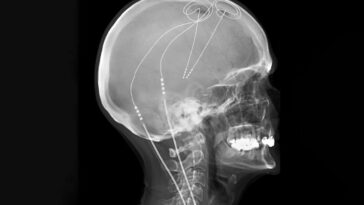 L'implant cérébral sur mesure soutient à long terme la douleur chronique