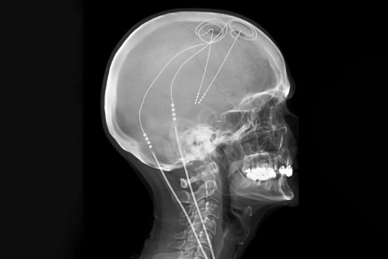 L'implant cérébral sur mesure soutient à long terme la douleur chronique