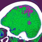 Où vous stockez la graisse peut influencer l'effet qu'il a sur votre cerveau