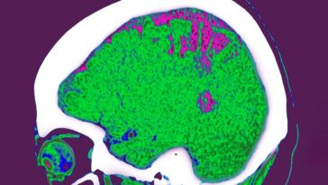Où vous stockez la graisse peut influencer l'effet qu'il a sur votre cerveau