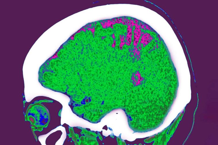 Où vous stockez la graisse peut influencer l'effet qu'il a sur votre cerveau
