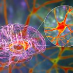 Percée de la maladie de Huntington: que savoir sur la thérapie génique