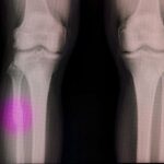 Un pistolet à colle chaude modifiée peut réparer les os cassés