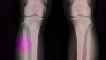 Un pistolet à colle chaude modifiée peut réparer les os cassés