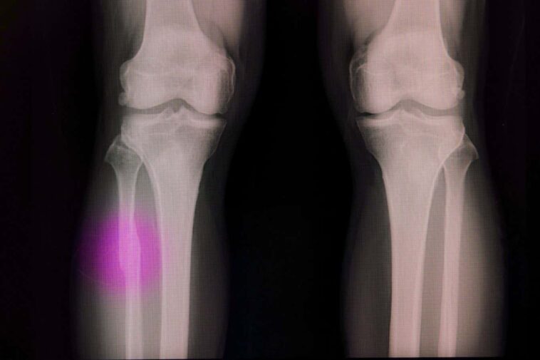 Un pistolet à colle chaude modifiée peut réparer les os cassés