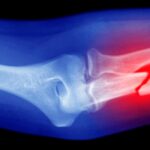 Une «imprimante osseuse» portable est prometteuse dans les tests animaux