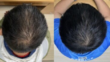The improvement in hair growth after 56 days of using the serum
