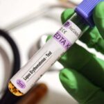 La preuve la plus solide à ce jour que le virus Epstein-Barr provoque le lupus