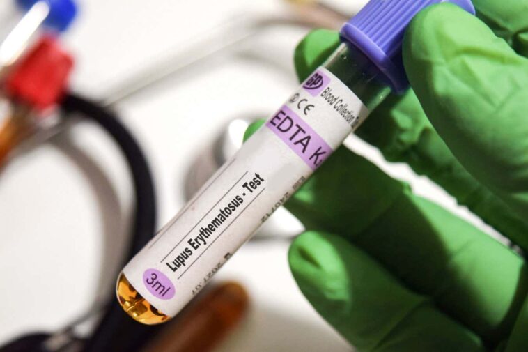 La preuve la plus solide à ce jour que le virus Epstein-Barr provoque le lupus