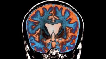 L’image d’un cerveau à l’intérieur d’un crâne est sur fond noir.