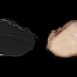 Une photo en gros plan d'une croissance tissulaire entourée d'os