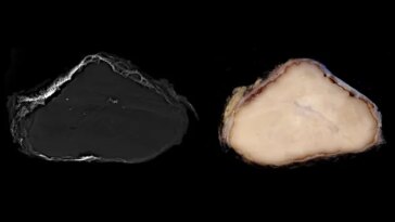 Une photo en gros plan d'une croissance tissulaire entourée d'os
