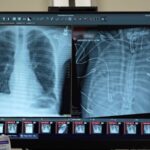 Des poumons artificiels ont maintenu un homme en vie jusqu'à ce qu'il puisse obtenir une greffe Des poumons artificiels ont maintenu un homme en vie jusqu'à ce qu'il puisse obtenir une greffe