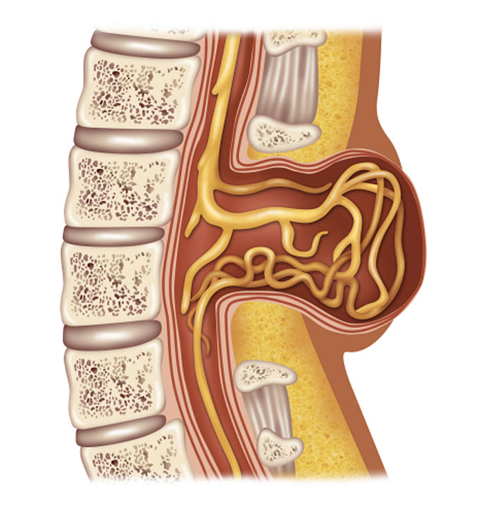 Une illustration du spina bifida.