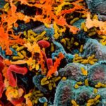 La cystite ou la carie dentaire pourraient déclencher la démence quelques années plus tard A scanning electron micrograph of E coli (yellow) infecting cells (blue) within a human bladder, causing them to secrete thick mucus (orange)