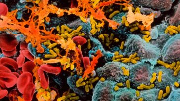 A scanning electron micrograph of E coli (yellow) infecting cells (blue) within a human bladder, causing them to secrete thick mucus (orange)