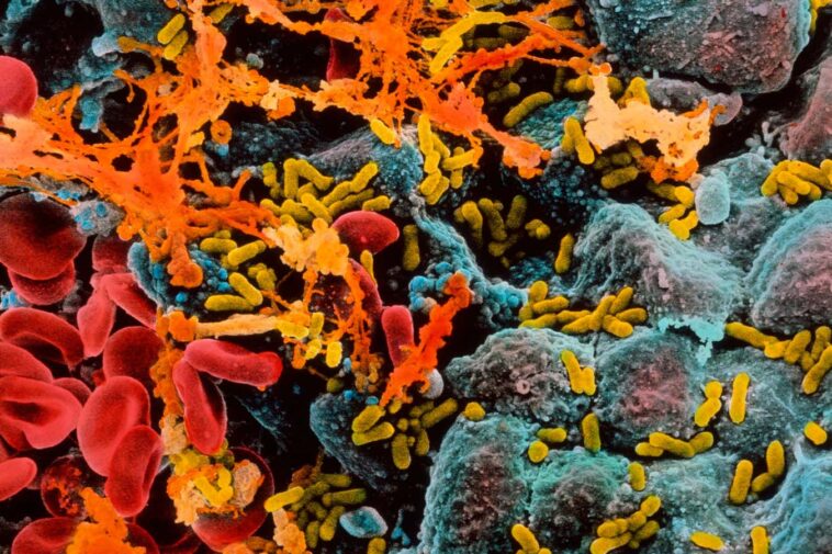 La cystite ou la carie dentaire pourraient déclencher la démence quelques années plus tard A scanning electron micrograph of E coli (yellow) infecting cells (blue) within a human bladder, causing them to secrete thick mucus (orange)