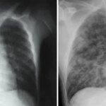 Deux images radiographiques de personnes infectées par le hantavirus des Andes. Sur la gauche, les poumons sont pour la plupart sombres avec un léger trouble là où du liquide s'est infiltré dans les petites voies respiratoires. À droite, les deux poumons sont remplis de voies respiratoires cotonneuses et remplies de liquide.