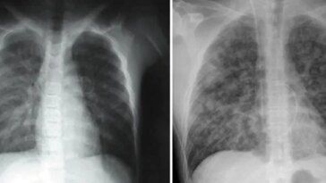 Deux images radiographiques de personnes infectées par le hantavirus des Andes. Sur la gauche, les poumons sont pour la plupart sombres avec un léger trouble là où du liquide s'est infiltré dans les petites voies respiratoires. À droite, les deux poumons sont remplis de voies respiratoires cotonneuses et remplies de liquide.