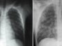 Deux images radiographiques de personnes infectées par le hantavirus des Andes. Sur la gauche, les poumons sont pour la plupart sombres avec un léger trouble là où du liquide s'est infiltré dans les petites voies respiratoires. À droite, les deux poumons sont remplis de voies respiratoires cotonneuses et remplies de liquide.