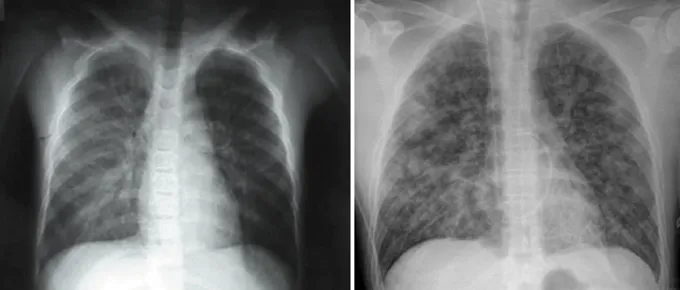 Pourquoi l'hantavirus est-il si mortel ? Ce n'est pas ce que tu penses Deux images radiographiques de personnes infectées par le hantavirus des Andes. Sur la gauche, les poumons sont pour la plupart sombres avec un léger trouble là où du liquide s'est infiltré dans les petites voies respiratoires. À droite, les deux poumons sont remplis de voies respiratoires cotonneuses et remplies de liquide.