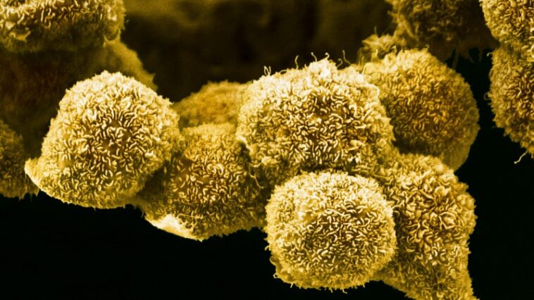 Une nouvelle pilule contre le cancer du pancréas pourrait changer la donne pour les patients Une nouvelle pilule contre le cancer du pancréas pourrait changer la donne pour les patients