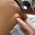 Un nouveau vaccin contre le cancer pourrait empêcher la récidive du mélanome