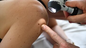 Un nouveau vaccin contre le cancer pourrait empêcher la récidive du mélanome
