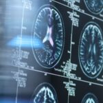 Les IRM montrent des changements cérébraux liés à la maladie d'Alzheimer des années à l'avance Les IRM montrent des changements cérébraux liés à la maladie d'Alzheimer des années à l'avance