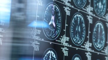 Les IRM montrent des changements cérébraux liés à la maladie d'Alzheimer des années à l'avance