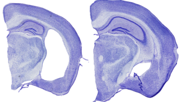 Deux tranches de cerveau de souris colorées en violet sont placées côte à côte. Celui de gauche présente une énorme lacune, signe de dommages semblables à ceux de la maladie d'Alzheimer.