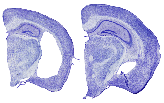 Deux tranches de cerveau de souris colorées en violet sont placées côte à côte. Celui de gauche présente une énorme lacune, signe de dommages semblables à ceux de la maladie d'Alzheimer.