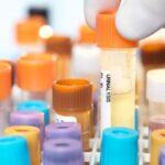 Un test de validation de principe peut détecter le cancer de la vessie dans l'urine Un test de validation de principe peut détecter le cancer de la vessie dans l'urine