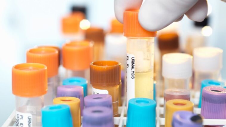 Un test de validation de principe peut détecter le cancer de la vessie dans l'urine